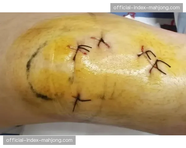 两次十字韧带手术后的回归:美国车手贾斯汀·道尔顿的坚持 两次十字韧带手术后的回归:美国车手贾斯汀·道尔顿的坚持